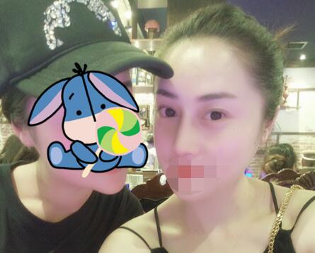 鼻头鼻翼缩小案例 鼻头鼻翼缩小案例