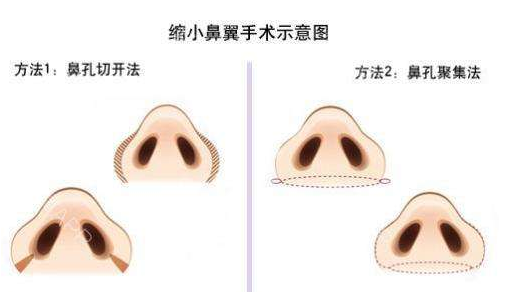 鼻头鼻翼缩小价格 南京做鼻头鼻翼缩小多少钱?鼻部整形价格