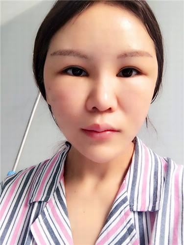 一直都想全脸填充脂肪!全脸几乎都凹陷!苹果肌打过玻尿酸!