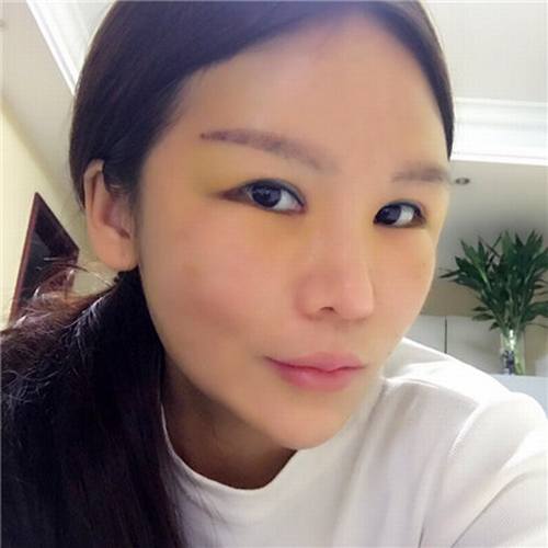 一直都想全脸填充脂肪!全脸几乎都凹陷!苹果肌打过玻尿酸!