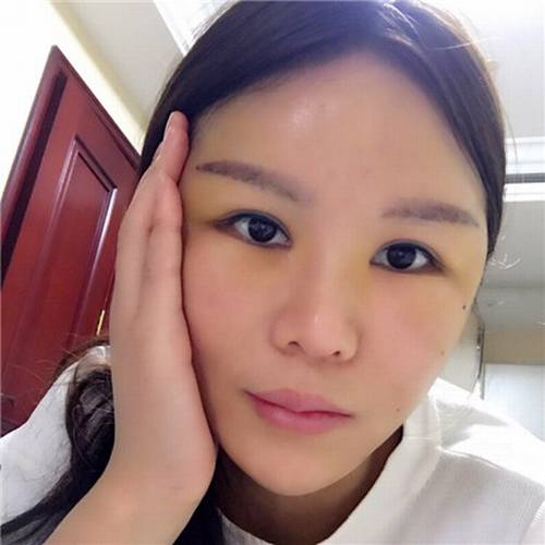 一直都想全脸填充脂肪!全脸几乎都凹陷!苹果肌打过玻尿酸!