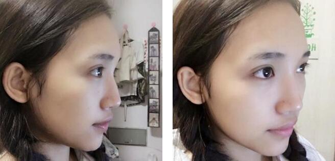 鼻部手术整形垫高鼻尖果怎样?案例分享