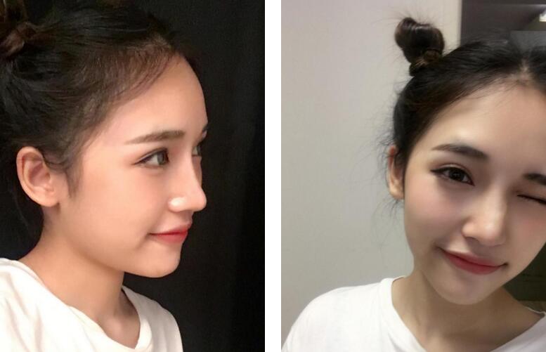 鼻部手术整形垫高鼻尖果怎样?案例分享