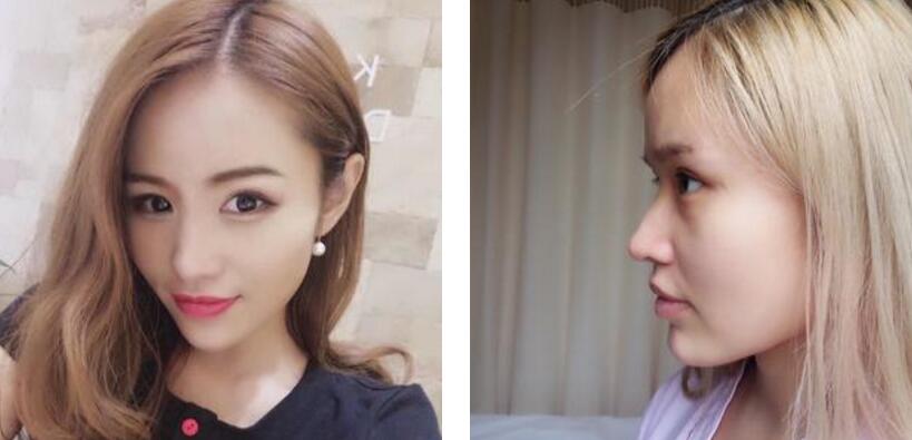 自体耳软骨隆鼻 自体耳软骨复合隆鼻案例