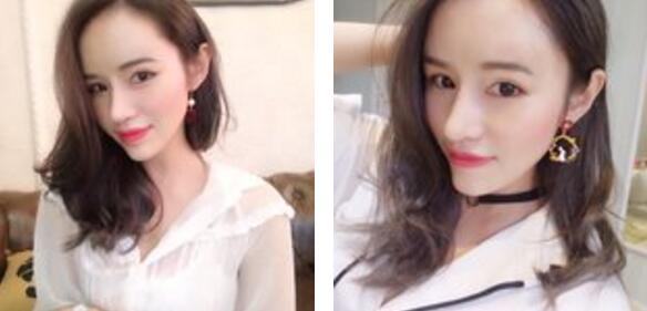 自体耳软骨隆鼻 自体耳软骨复合隆鼻案例