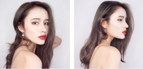 自体耳软骨隆鼻 自体耳软骨复合隆鼻案例