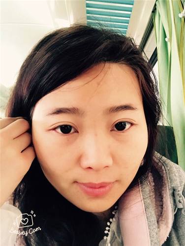 分享两个玻尿酸隆鼻案例,看看你们的玻尿酸术后和他们有啥不同?整形嘛,因人而异的多,哈哈哈哈