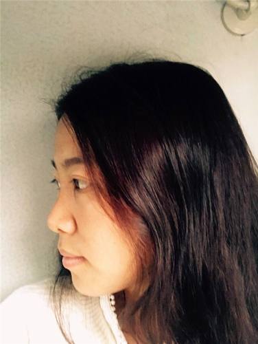 分享两个玻尿酸隆鼻案例,看看你们的玻尿酸术后和他们有啥不同?整形嘛,因人而异的多,哈哈哈哈