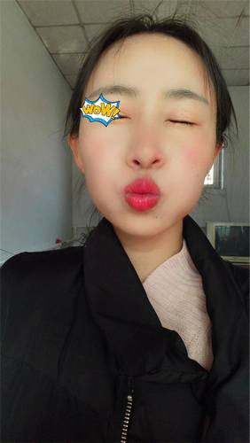 朋友们来看看我的缩鼻翼术后3个月对比照片,你心动了吗?