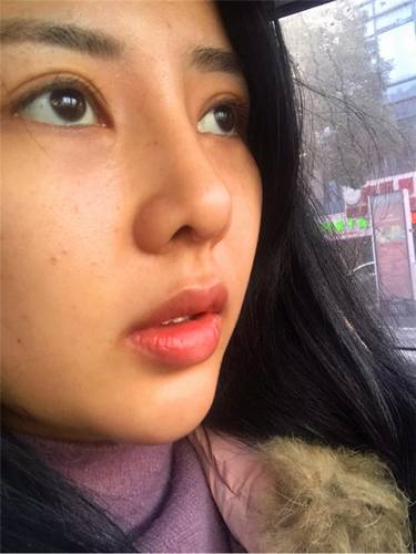 长沙真爱黄志鹏做的鼻部手术,隆鼻术后对比图