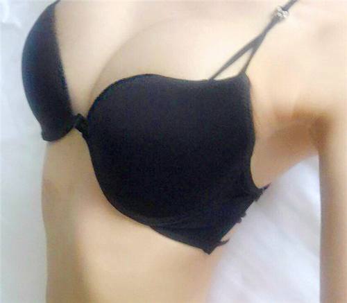 上海伊莱美自体脂肪隆胸术后对比照片案例