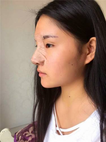 上海美联臣假体隆鼻部手术术后对比照片案例