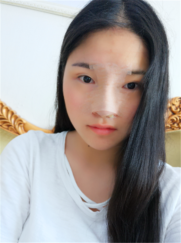 上海美联臣假体隆鼻部手术术后对比照片案例