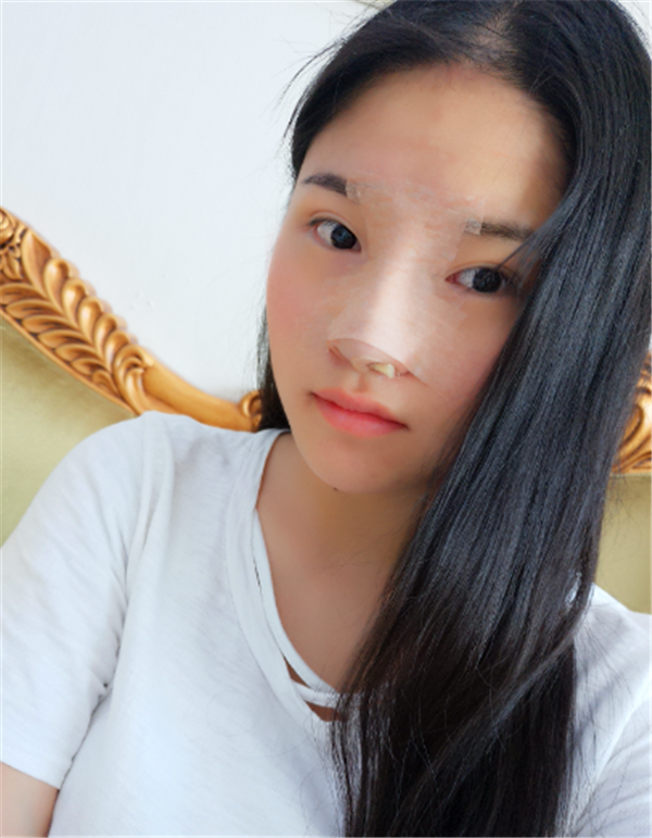 上海美联臣假体隆鼻部手术术后对比照片案例
