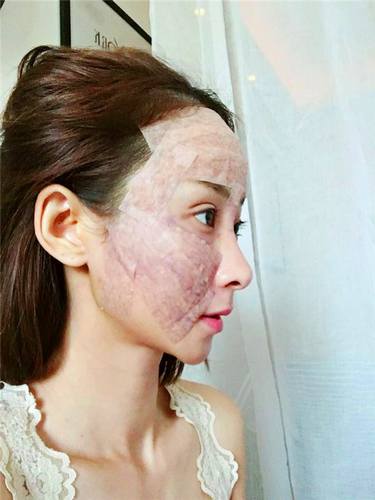 上海时光自体脂肪全脸填充术后对比照片案例