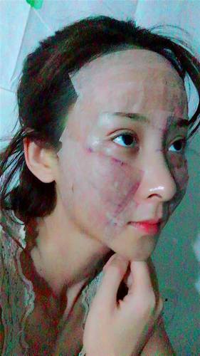 上海时光自体脂肪全脸填充术后对比照片案例