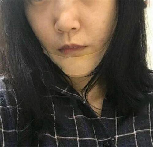上海首尔丽格硅胶假体垫下巴术后对比照片案例