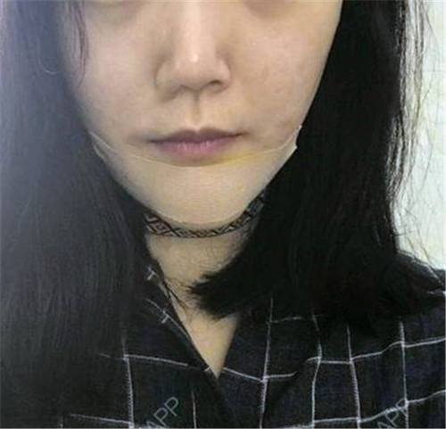 上海首尔丽格硅胶假体垫下巴术后对比照片案例