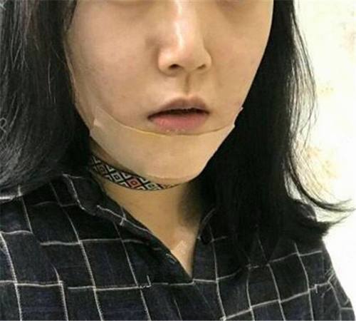 上海首尔丽格硅胶假体垫下巴术后对比照片案例