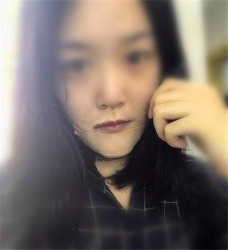 上海首尔丽格硅胶假体垫下巴术后对比照片案例