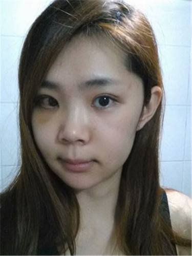上海市东方医院郭军下颌角整形前后对比案例