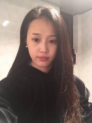 成都玉之光黄开亮鼻部修复对比案例