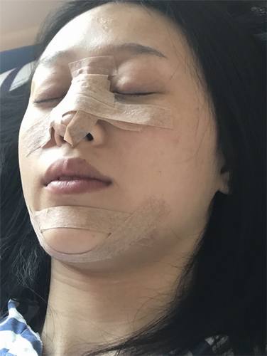 成都玉之光黄开亮鼻部修复对比案例