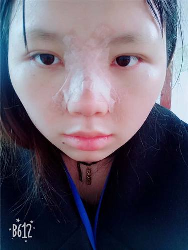 武汉洪山爱美汇瞿敏鼻部手术案例分享