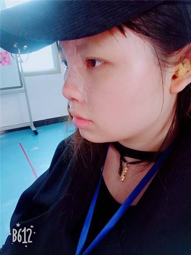 武汉洪山爱美汇瞿敏鼻部手术案例分享