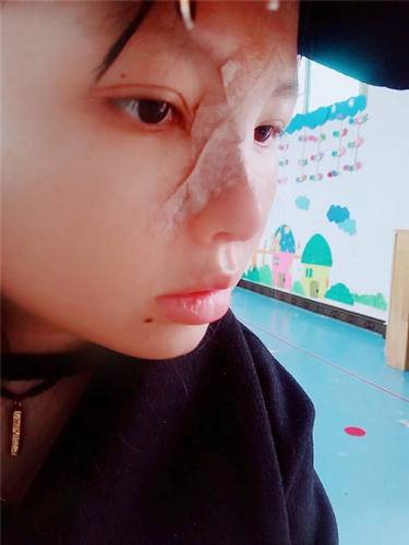 武汉洪山爱美汇瞿敏鼻部手术案例分享