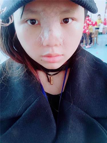 武汉洪山爱美汇瞿敏鼻部手术案例分享