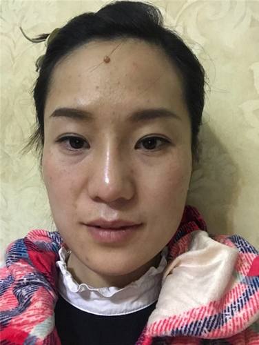 成都菲格蒋中川鼻部手术真实案例
