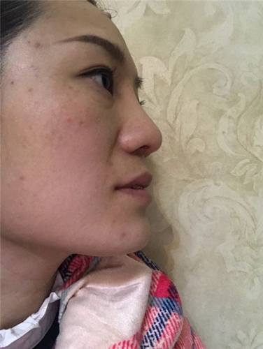 成都菲格蒋中川鼻部手术真实案例