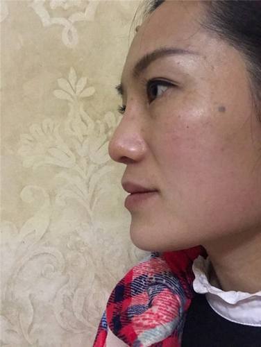 成都菲格蒋中川鼻部手术真实案例