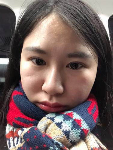 北京清木石晓川自体脂肪全脸填充