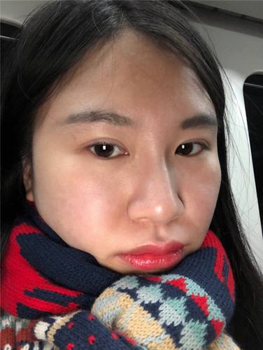 北京清木石晓川自体脂肪全脸填充