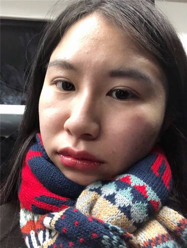 北京清木石晓川自体脂肪全脸填充