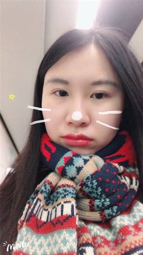 北京清木石晓川自体脂肪全脸填充