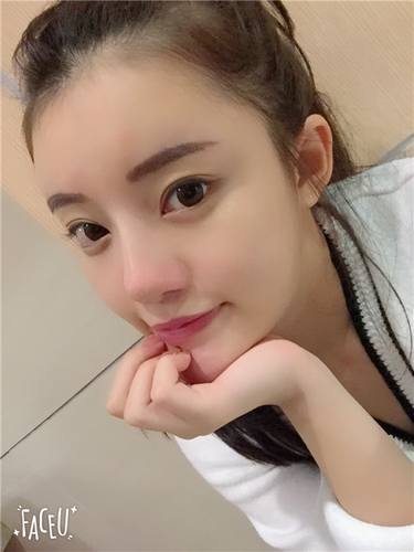 武汉韩辰自体脂肪全脸填充案例