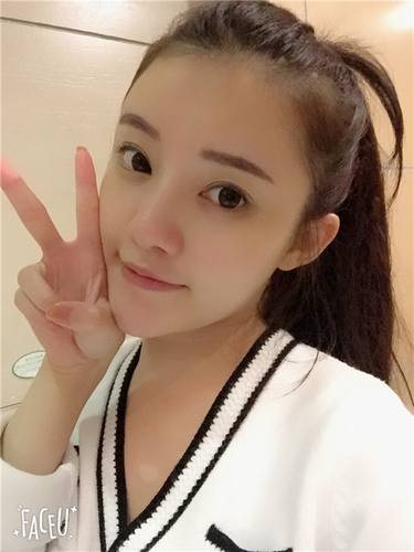 武汉韩辰自体脂肪全脸填充案例