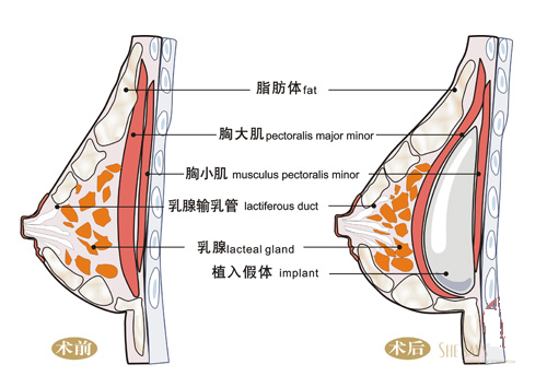 隆胸的方法有哪些？假体隆胸可能带来的危害是什么？