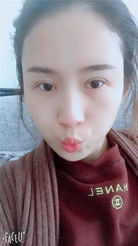 我终于有双眼皮啦!!眼睛变得炯炯有神了~~这个圣诞节可以美美的过了哈哈~~~
