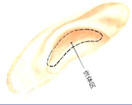 鼻整形中常说的自体软骨有哪些?