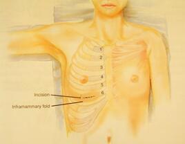 鼻整形中常说的自体软骨有哪些?