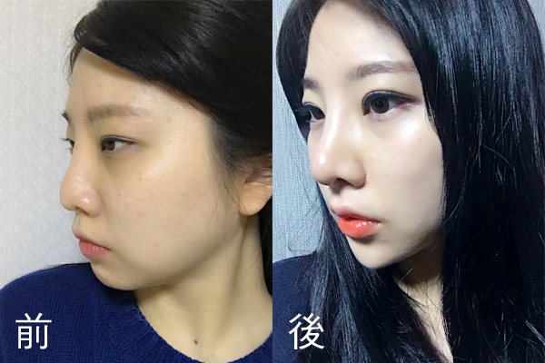 鼻整形中常说的自体软骨有哪些?