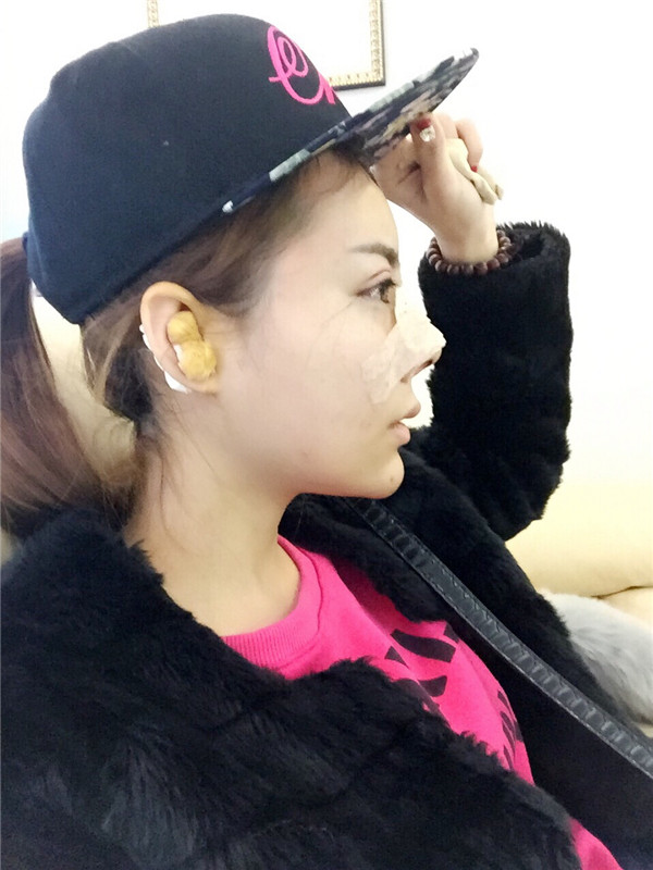 有没有人和我一样,鼻子眼睛一起做的,变化真的好大啊!!进来看看我的鼻部手术加割双眼皮的案例吧~~~(#^.^#)