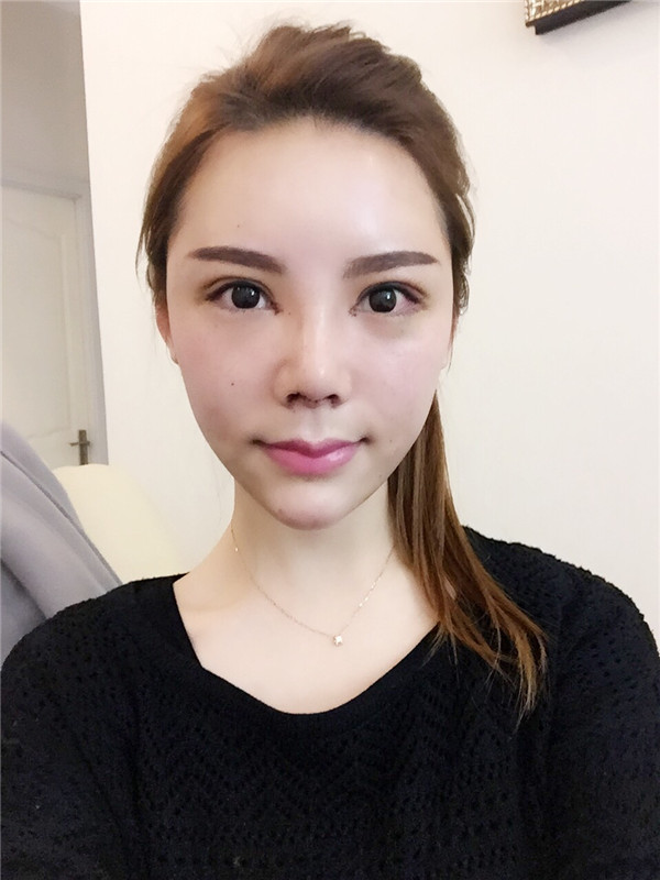 有没有人和我一样,鼻子眼睛一起做的,变化真的好大啊!!进来看看我的鼻部手术加割双眼皮的案例吧~~~(#^.^#)