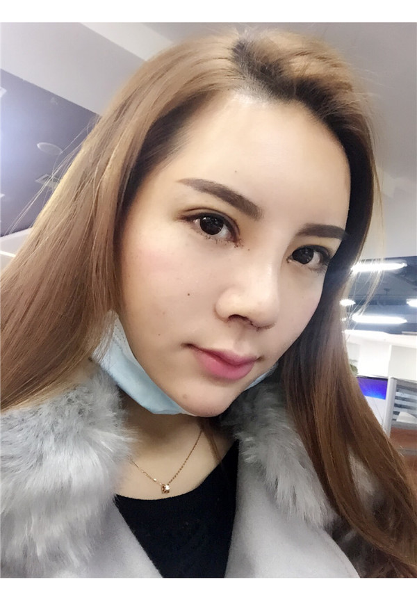 有没有人和我一样,鼻子眼睛一起做的,变化真的好大啊!!进来看看我的鼻部手术加割双眼皮的案例吧~~~(#^.^#)