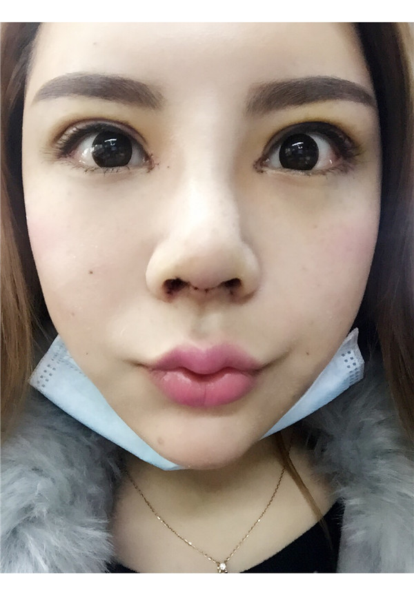 有没有人和我一样,鼻子眼睛一起做的,变化真的好大啊!!进来看看我的鼻部手术加割双眼皮的案例吧~~~(#^.^#)
