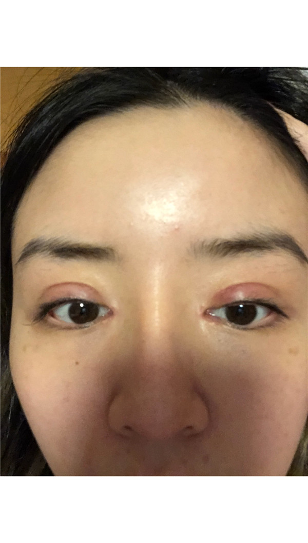 知道什么是睑缘微创吗?快进来看看我的双眼皮案例,术后不会有疤痕哦!!!